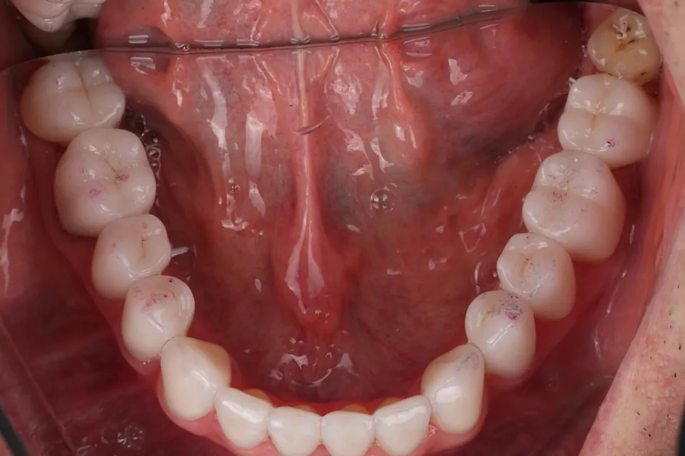 Lower dental arch: chewing surfaces.