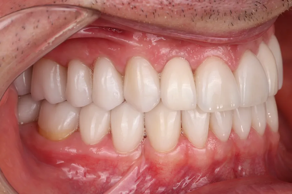 Ceramic restorations: side view.