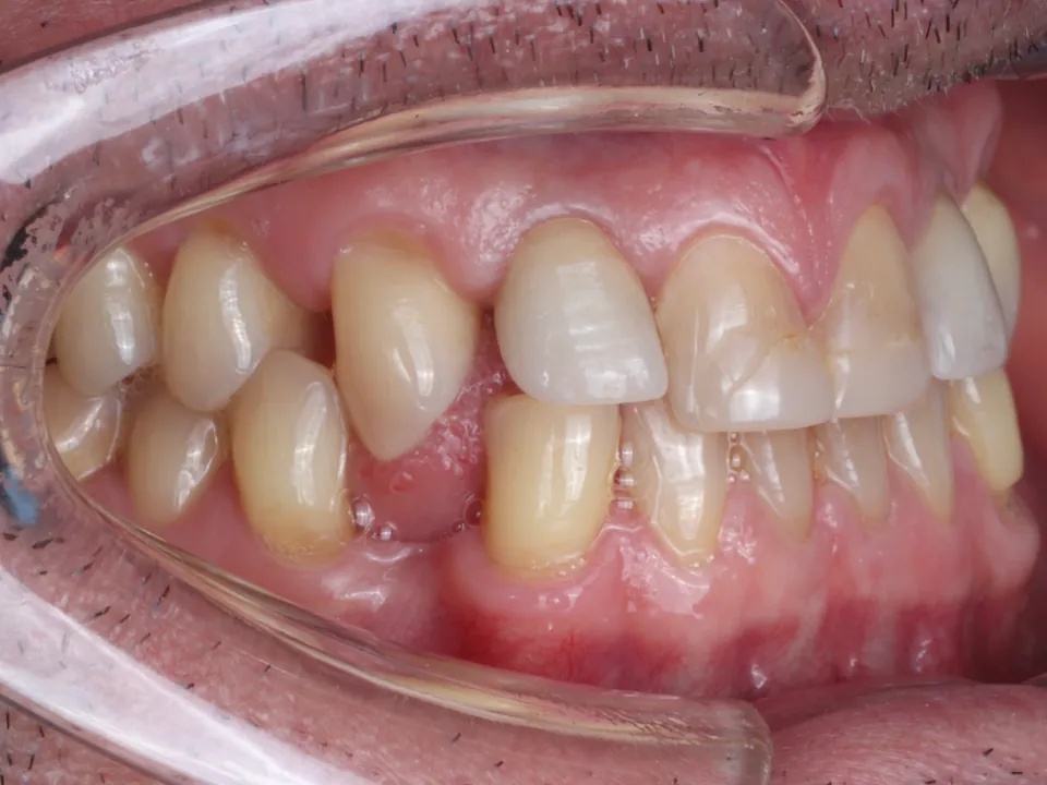 Dental arches before treatment: side view.