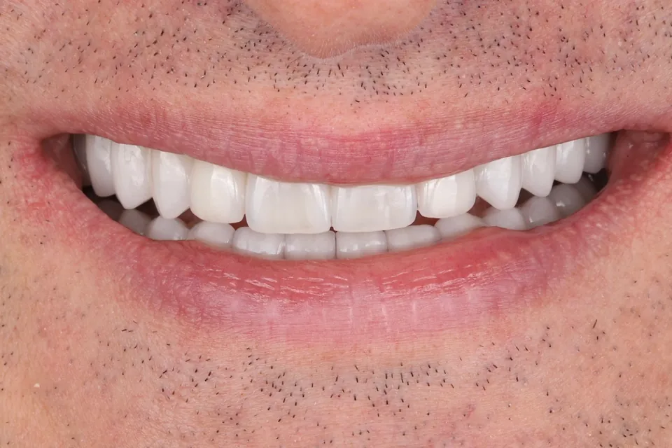 Smile after treatment.