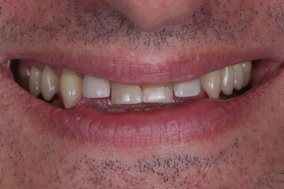 Smile before treatment.
