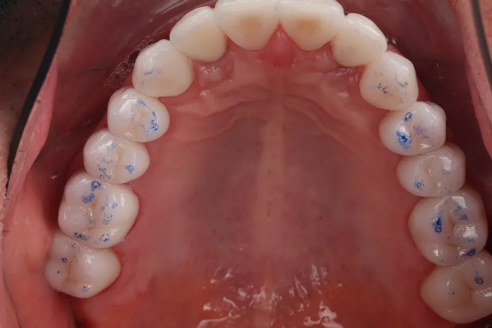 Upper dental arch: chewing surfaces.