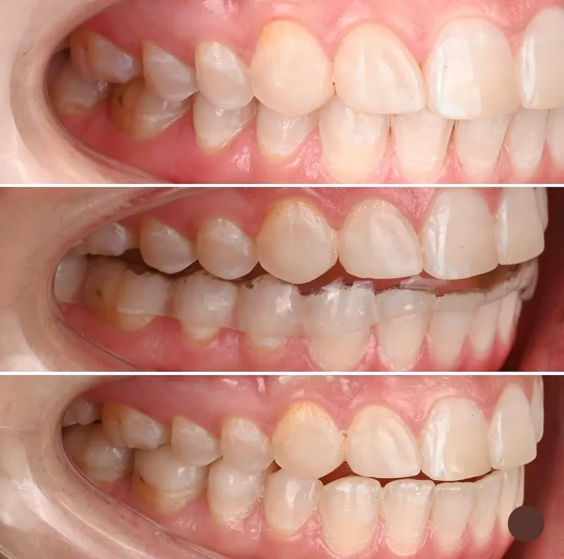 The patient’s teeth without a splint and with a lower-jaw splint